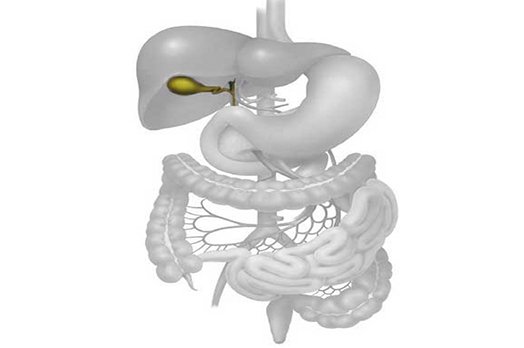 Colecistitis que es