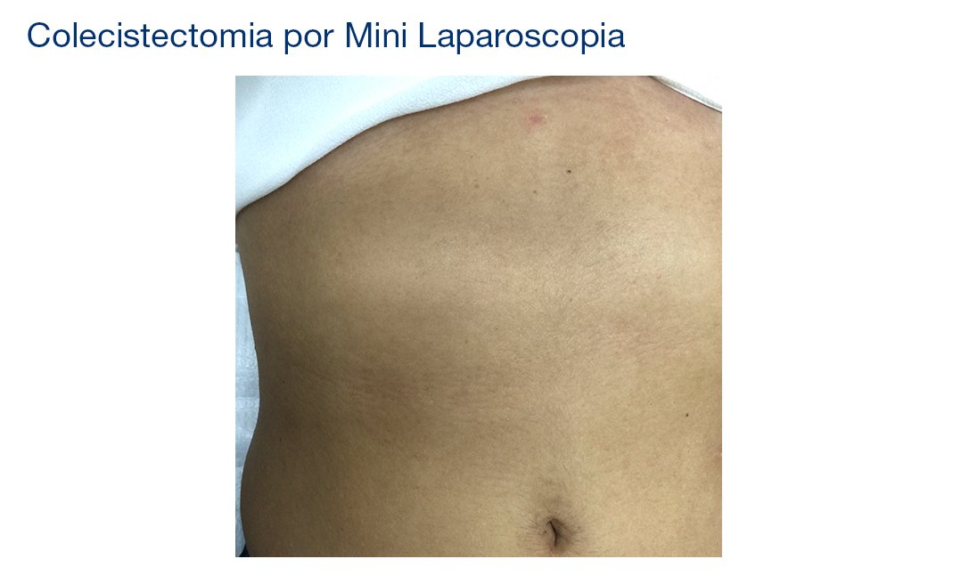 Colecistectomia Por Mini Laparoscopia