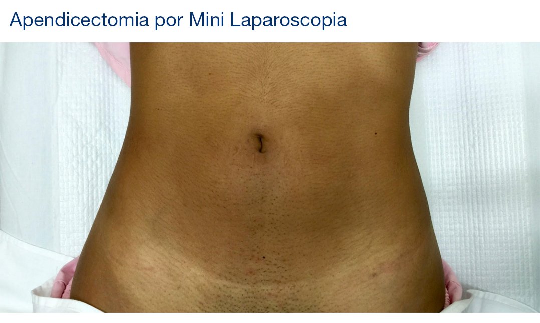 Apendicectomia Por Mini Laparoscopia