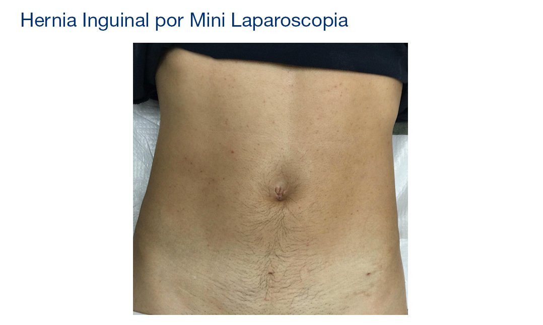 Mini Laparoscopia
