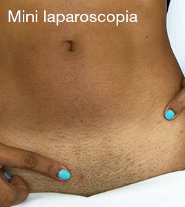 Mini Laparoscopia